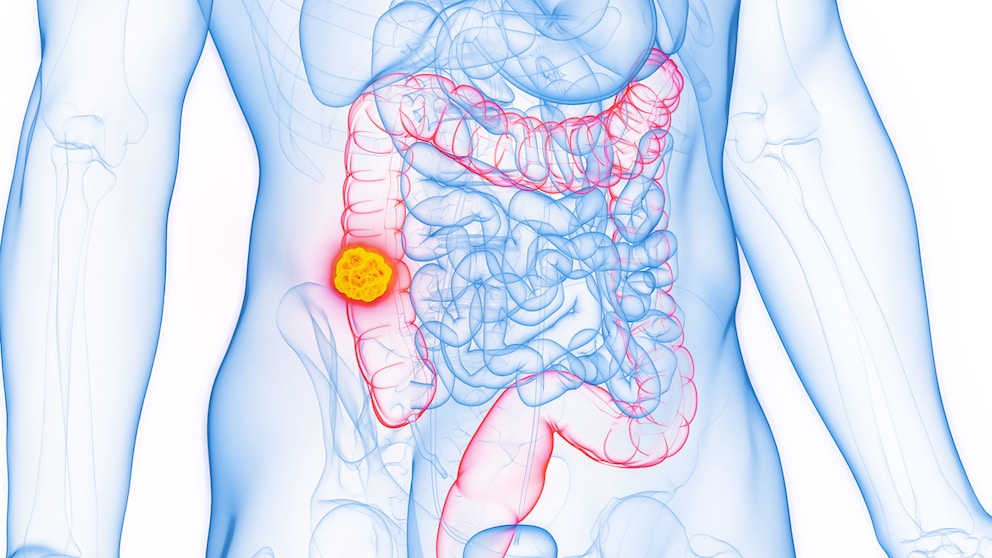 Männer sollten auf ihre Ernährung achten, um ihr Darmkrebsrisiko zu reduzieren