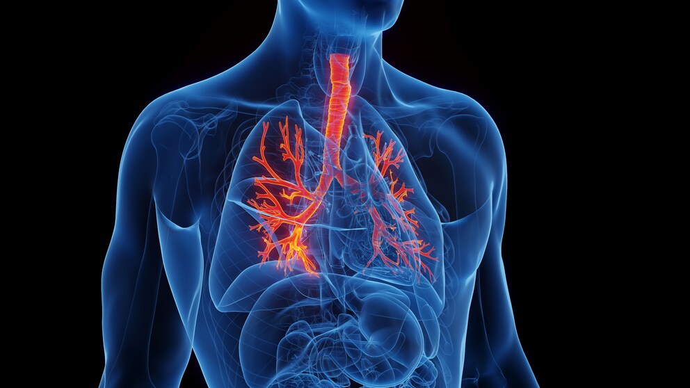 Bei einem Lungenemphysem werden die Bronchien irreparabel geschädigt, sodass der Körper nicht mit genug Sauerstoff versorgt werden kann