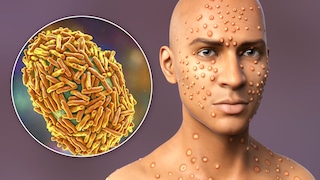 Mpox-Virus