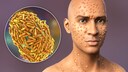 Mpox-Virus