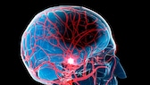 Schlafstörungen scheinen mit einem höheren Schlaganfallrisiko in Verbindung zu stehen
