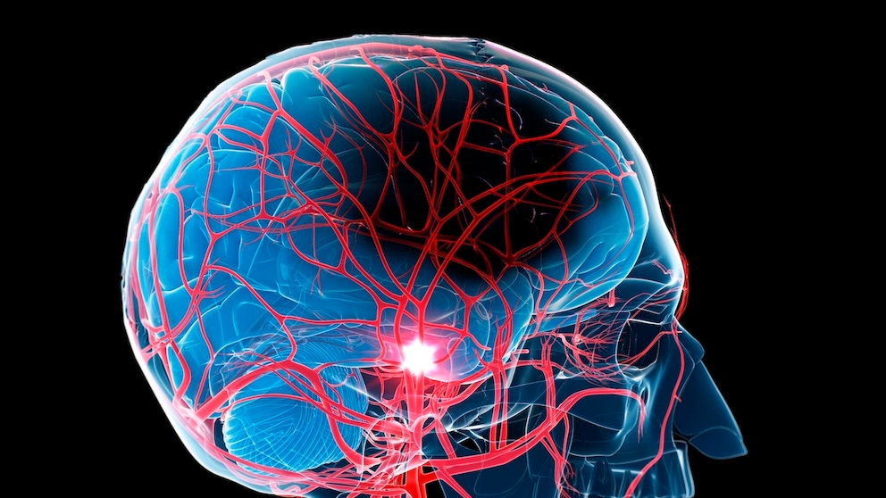 Schlafstörungen scheinen mit einem höheren Schlaganfallrisiko in Verbindung zu stehen