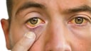 Gelbsucht äußert sich in einer gelblichen Färbung der Augen.