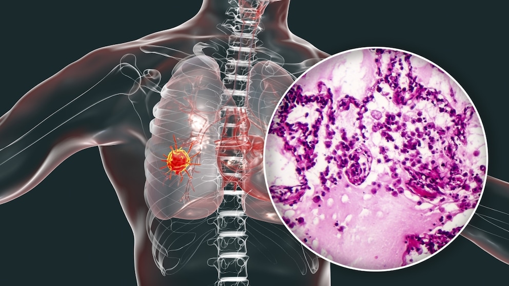 Lungenkrebs ist ein bösartiger Tumor, der sich in der Lunge des Menschen bilden kann.