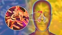Symptome, Ursachen und Therapie einer Nasennebenhöhlenentzündung (Sinusitis)