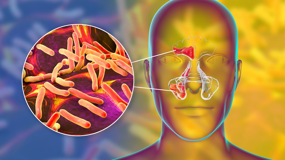 Symptome, Ursachen und Therapie einer Nasennebenhöhlenentzündung (Sinusitis)