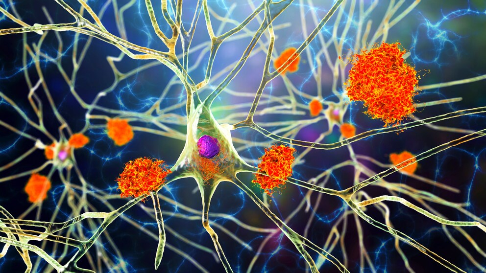 Bei der Alzheimer-Erkrankung schädigen Proteinablagerungen (hier orange illustriert) die Nervenzellen im Gehirn