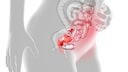 Endometriose