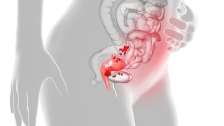 Endometriose