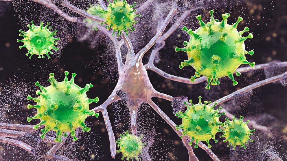 Herpes-Viren können im schlimmsten Fall sogar zu einer Gehirnentzündung (Enzephalitis) führen.