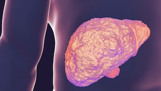 Leberfibrose