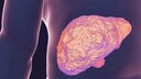 Leberfibrose