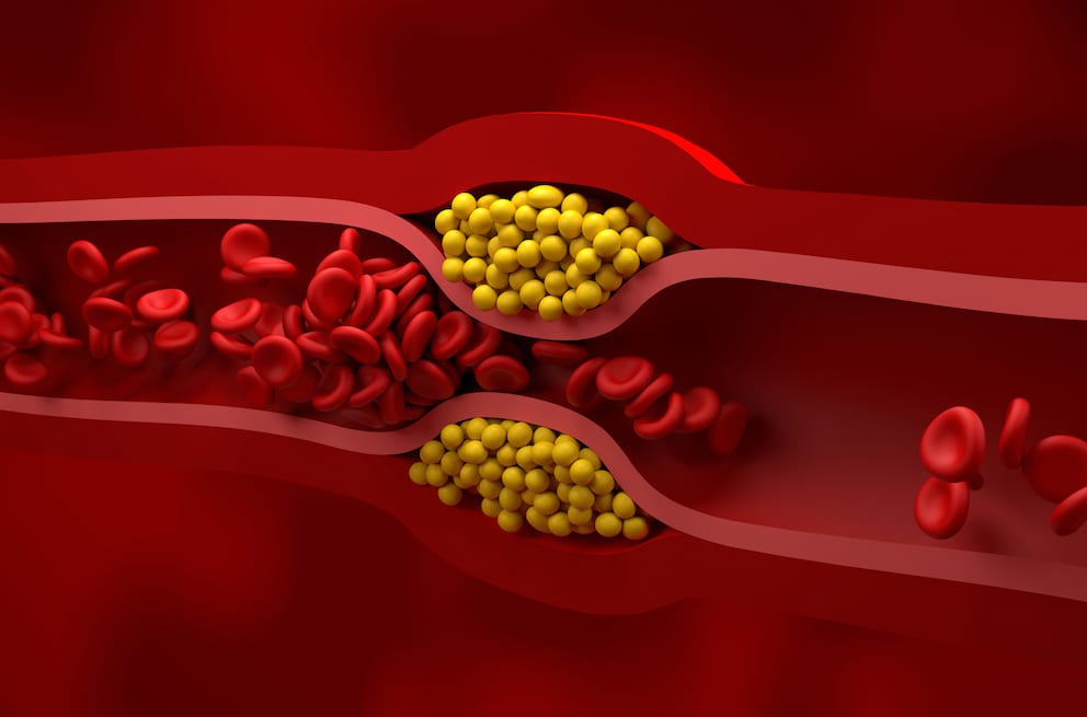 Forscher entdecken weiteres Lipid, welches Arteriosklerose auslösen kann