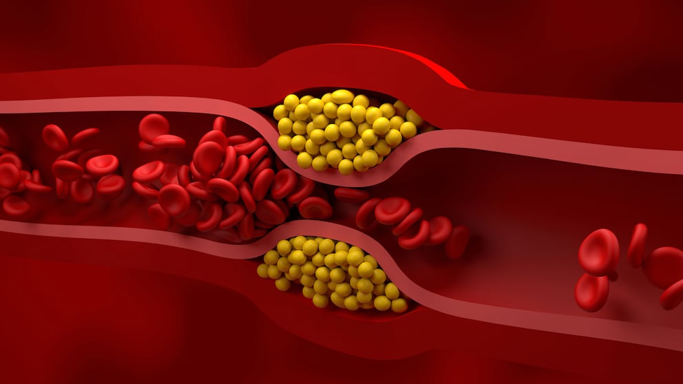 Sphingolipide Arteriosklerose
