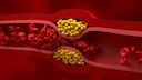Sphingolipide Arteriosklerose
