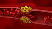 Sphingolipide Arteriosklerose