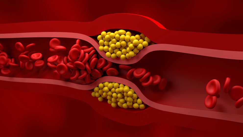 Sphingolipide Arteriosklerose