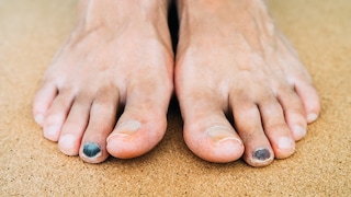 Runners Toe