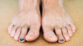 Runners Toe