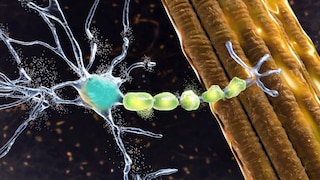 Bei einer Erkrankung an ALS (Amyotrophe Lateralsklerose) degenerieren die Nervenzellen