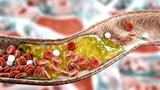 Arteriosklerose
