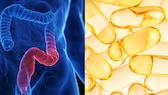 Wie Vitamin D helfen kann, Colitis-ulcerosa-Symptome zu lindern