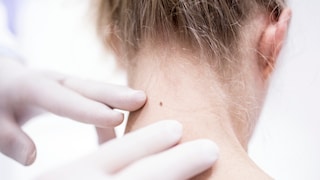 Gewisse Hautveränderungen können auf Hautkrebs hinweisen