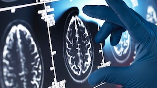 Frauen Männer Alzheimer
