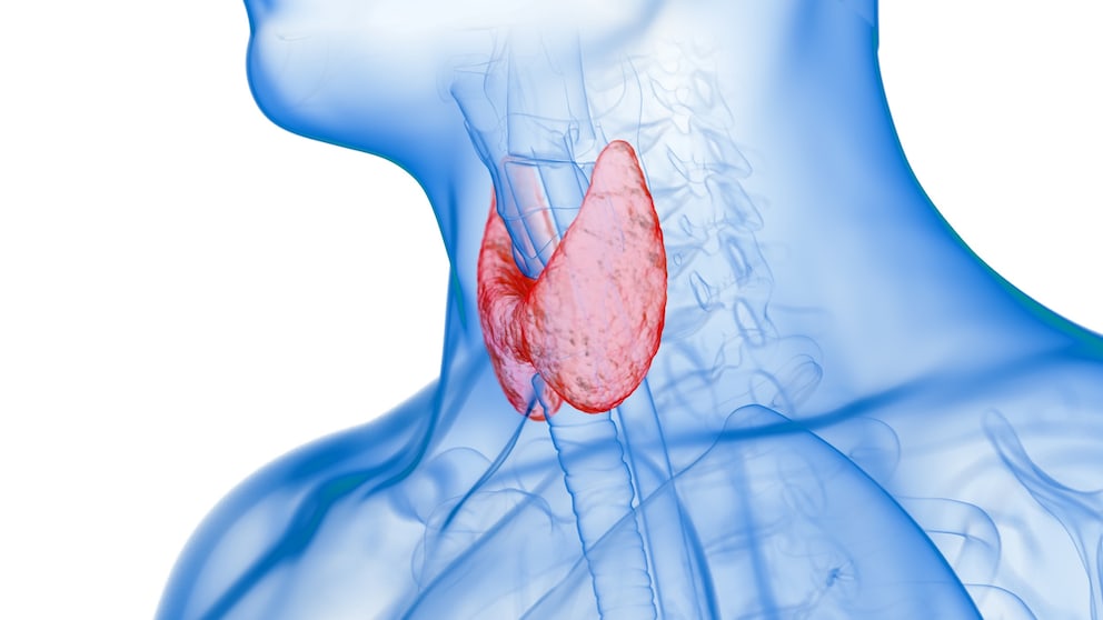 Inflamed thyroid gland, illustration.