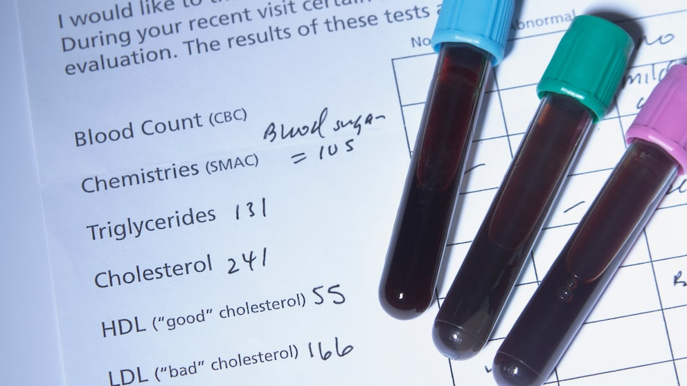 Cholesterinwerte in Laboranalyse