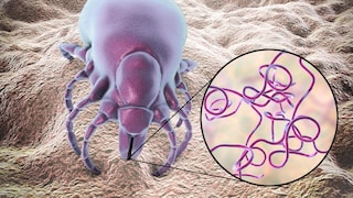 Lyme-Borreliose kann von Zecken übertragen werden