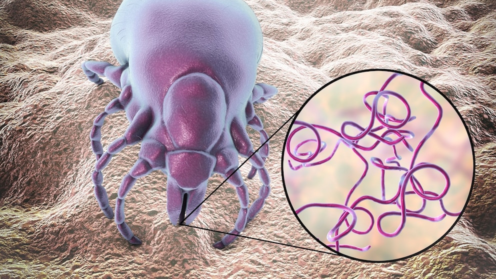 Lyme-Borreliose kann von Zecken übertragen werden