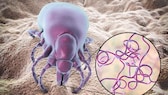 Lyme-Borreliose kann von Zecken übertragen werden
