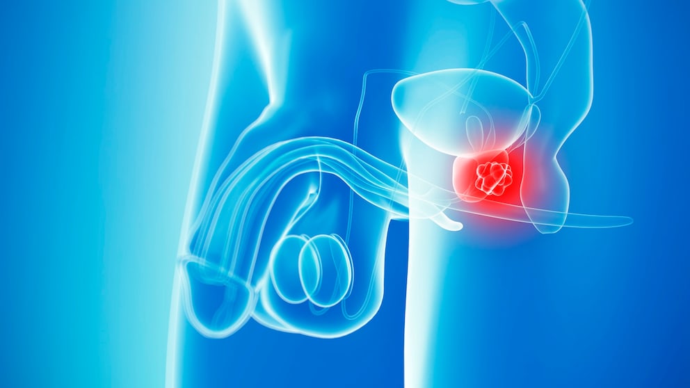 Bei Joe Biden wurde Prostatakrebs diagnostiziert