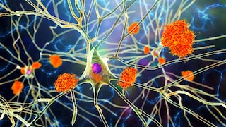 Laut Studie begünstigt Sitzen Alzheimer