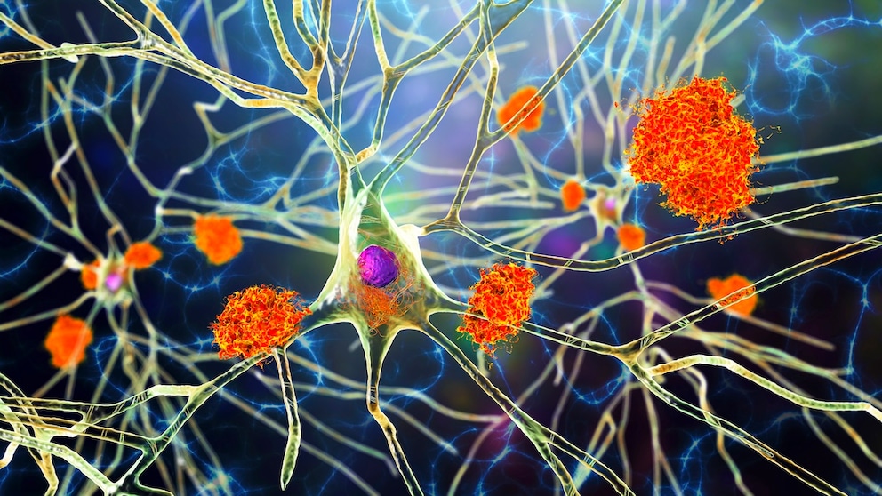 Laut Studie begünstigt Sitzen Alzheimer