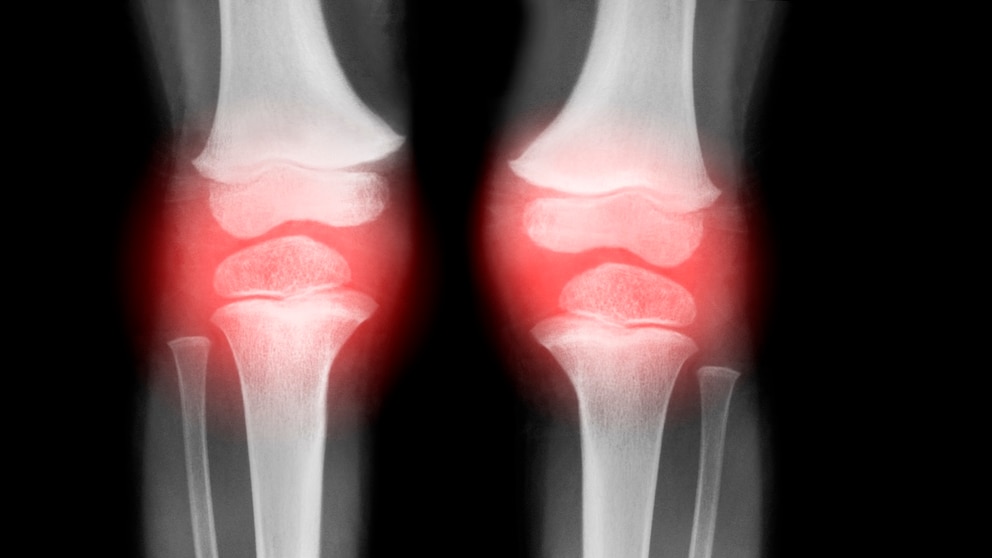 Die richtige Ernährung kann den Verlauf von Arthrose beeinflussen