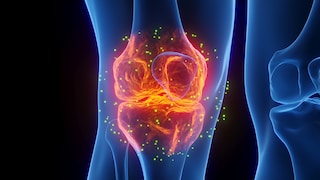 Arthrose