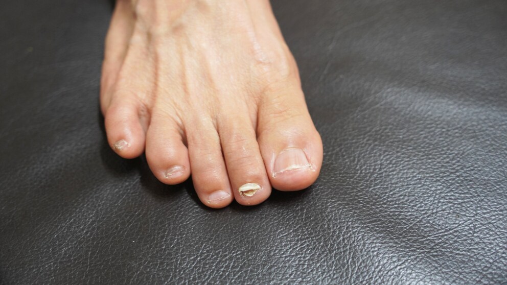 Nagelpilz kann an Händen und Füßen auftreten. Die Behandlung dauert teils Monate