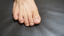 Nagelpilz kann an Händen und Füßen auftreten. Die Behandlung dauert teils Monate