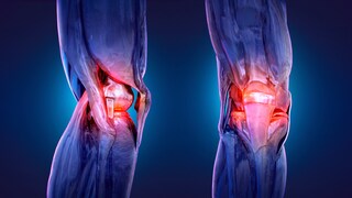 O-Beine Arthrose