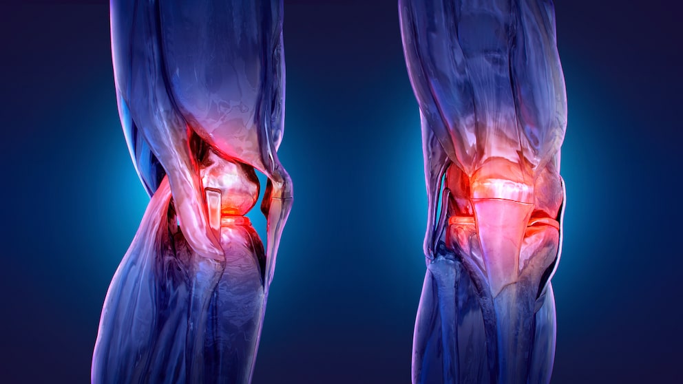 O-Beine Arthrose