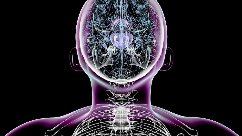 Parkinson