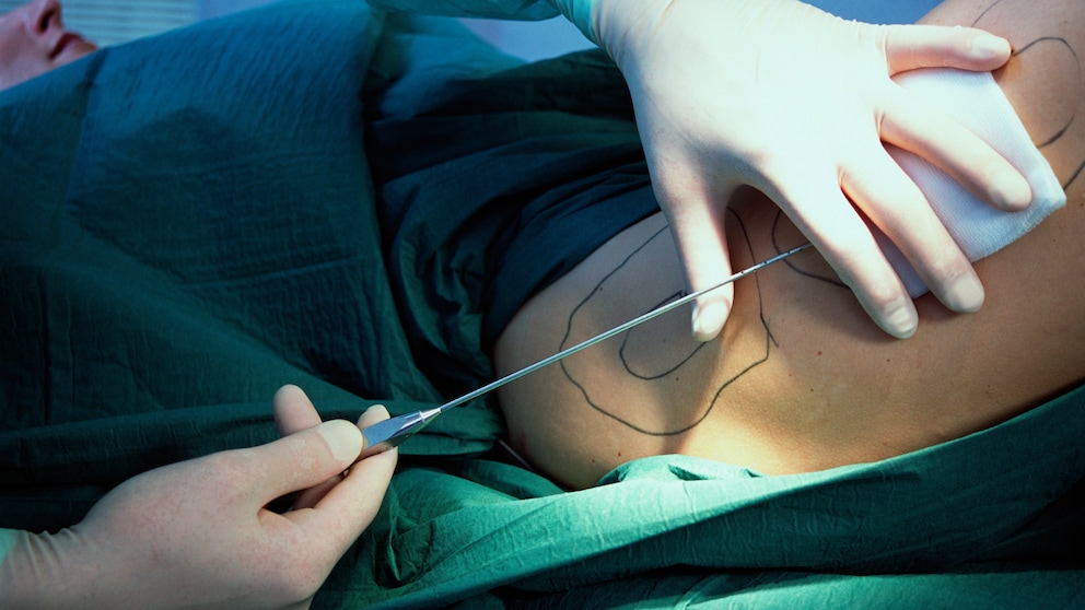 Lipödem kann große Schmerzen verursachen und wird häufig nicht korrekt diagnostiziert, jetzt bezahlt die Krankenkasse die Fettabsaugung.