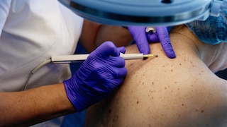 Hautkrebs Herpes