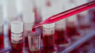 Auffälligkeiten im Blut von Frauen mit Alzheimer