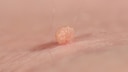 Fibrom sind Stielwarzen