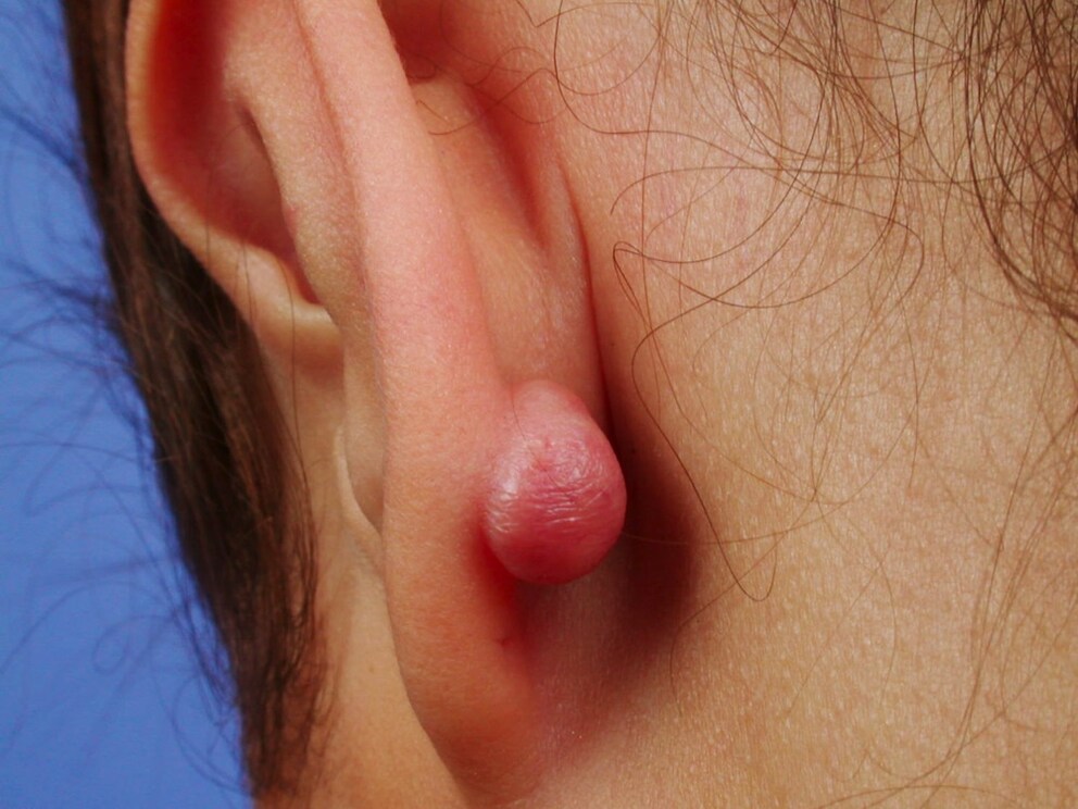 Growth on the ear