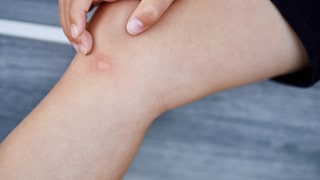 Ob Hausmittel oder natürliche Helfer – es gibt einiges, das den Juckreiz nach einem Mückenstich vorübergehend abschwächen kann