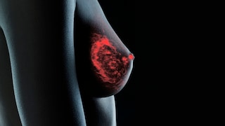 Wenn ein Tumor streut, lösen sich Krebszellen vom Ursprungstumor und gelangen über Blut oder Lymphe in andere Organe